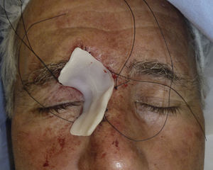 Aplicación de cera para huesos en la herida.