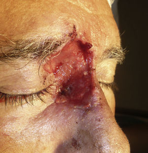 Aspecto de la herida una semana después.