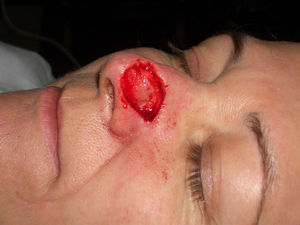 Defecto quirúrgico inmediatamente después de la cirugía de Mos.