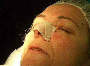 Aplicación de cera para huesos en la herida.