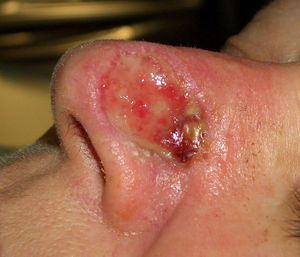 Aspecto de la herida una semana después de aplicar cera para huesos.