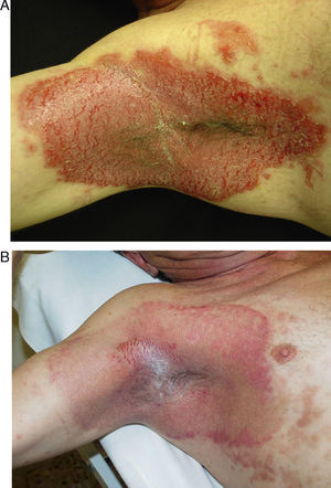 Paciente de 56 años con intensa afectación por enfermedad de Hailey-Hailey en ambas axilas. A. Imagen del paciente un mes después del procedimiento. B. Nótese la gran mejoría de las lesiones y la pequeña zona de recidiva en el hueco axilar. El paciente desestimó hacer una nueva sesión parcial de láser en esa pequeña área.