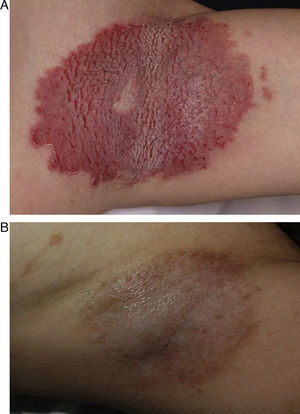 Paciente de 47 años con afectación por enfermedad de Hailey-Hailey axilar.A. Resultado tras un año del procedimiento. B. Hiperpigmentación postinflamatoria sin recidiva de las lesiones.