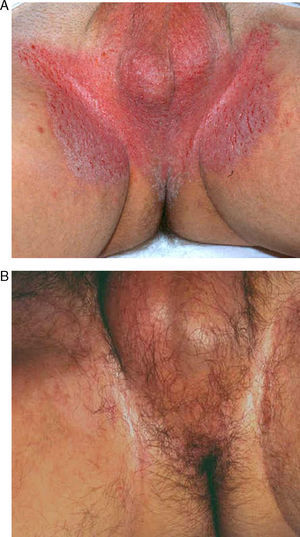 Paciente de 63 años con pénfigo benigno familiar de afectación inguinal.A. Imagen del mismo paciente un mes después de la intervención.B. Se aprecia el eritema postabrasión.