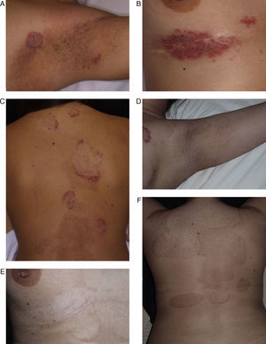 Paciente de 29 años afecta de enfermedad de Hailey-Hailey. A. Presentaba lesiones en la región axilar.B. Lesiones en la región submamaria. C. Lesiones en la superficie posterior del tronco. D, E y F. Imagen de las lesiones 9 meses después de realizar el tratamiento. Nótese la gran mejoría de las lesiones y las zonas de hipo/hiperpigmentación residual que ha dejado la abrasión. A pesar de los cambios de coloración, la paciente decidió realizar una nueva sesión de tratamiento en otras localizaciones.