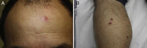 A. Pápula eritematosa sin costra en la superficie. B. Múltiples lesiones en la pierna de un paciente.