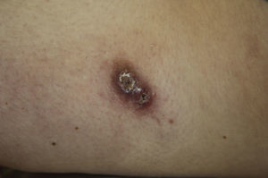 Lesión tipo botón de Oriente.