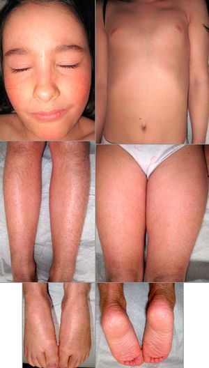 Clinical picture at the age of 9: lamellar ichthyosis.