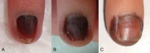 A. Imagen clínica inicial, melanoniquia homogénea marrón. B. A los 2 meses la afectación periungueal ya era clínicamente visible. C. A los 6 meses de seguimiento el componente periungueal era más evidente.