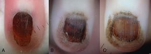 A. La dermatoscopia inicial puso de manifiesto la presencia de glóbulos pigmentados en la lámina ungueal y en la piel periungueal proximal. B. A los 2 meses se observaban glóbulos pigmentados sobre un fondo marrón, con líneas longitudinales finas y regulares en la lámina ungueal. C. A los 6 meses el patrón dermatoscópico permanecía estable.