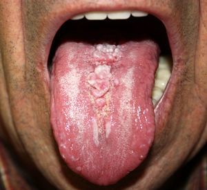 Lesión globulosa, elástica y de color rosado en la línea media del dorso de la lengua.