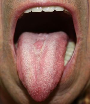 Aspecto de la lesión tras un mes de tratamiento con antifúngicos tópicos y reducción del consumo de tabaco.