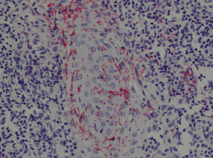 Biopsia del caso 2 con detección de múltiples espiroquetas invadiendo el folículo piloso. Existía un marcado epiteliotropismo epidérmico y perifolicular. (inmunohistoquímica anticuerpos antitreponema, ×200).