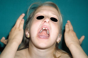 Síndrome EEC: paciente con ectrodactilia, paladar hendido, anodontia y disgenesia dental.