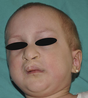 Síndrome AEC: la paciente presenta una hendidura palpebral disminuida, pelo escaso y labio leporino (reparado quirúrgicamente).