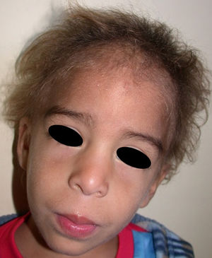 Displasia ectodérmica hidrótica. Cabello escaso y de aspecto tosco (cortesía de la doctora Isabel Febrer).