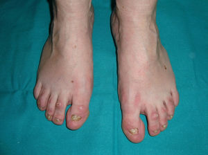 Displasia ectodérmica hidrótica. Distrofia ungueal en las uñas de los pies (cortesía de la doctora Isabel Febrer).