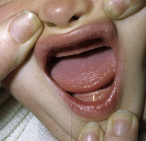 Hipoplasia alveolar en un lactante con DEH-X.
