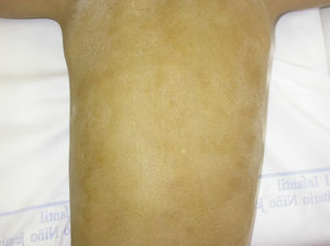 DE hipohidrótica: el test de Minor o de yodo-almidón demuestra la ausencia o disminución de la sudoración en los individuos afectados. En este paciente se observaba la práctica ausencia de sudoración en el tronco.