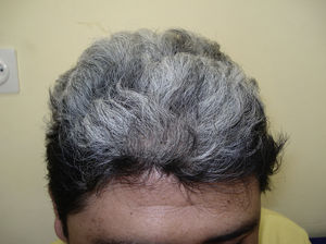 Recuperación completa de la alopecia tras el tratamiento, con crecimiento de pelo gris-blanquecino.