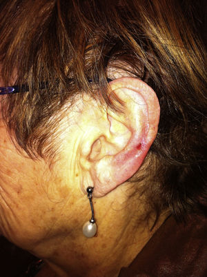 Úlcera eritematosa en el hélix de la oreja izquierda, compatible con condrodermatitis nodularis helicis.