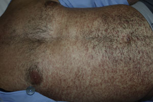 Exantema consistente en máculas y pápulas de color rojo intenso que afecta al tronco.