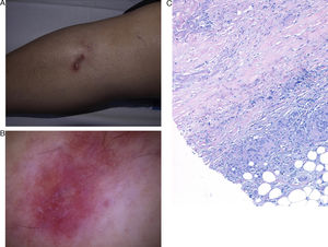 A. Placa eritematoviolácea de 2cm de diámetro mayor, de bordes bien definidos en la región pretibial derecha. B. Vasos en coma, estructuras blanquecinas sobre fondo rosado, zonas de color marrón-anaranjado y vasos en malla en el polo superior de la imagen dermatoscópica. C. Histológicamente se observan en la dermis bandas alternas de granuloma en empalizada y colágeno alterado, además de un intenso infiltrado inflamatorio perivascular (hematoxilina-eosina × 100).