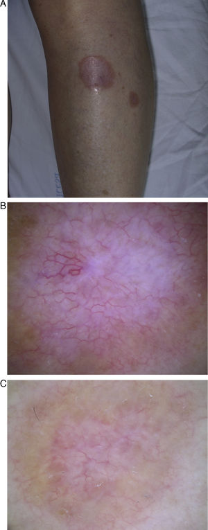A. Placas eritematosas en la región pretibial izquierda, la de mayor tamaño con atrofia central. B y C. Con el dermatoscopio se observa en ambas lesiones abundantes vasos dispuestos en forma de red o malla sobre un fondo rosado y áreas homogéneas amarillo-anaranjadas.