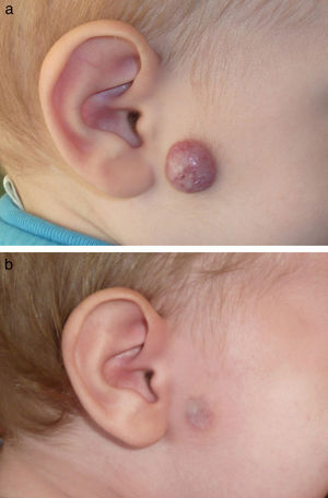 A. Paciente número 5 con hemangioma infantil en el inicio de su fase de involución. B. Resolución de la lesión tras 3 sesiones de tratamiento, persistiendo una leve discreta atrofia cutánea en la zona tratada.