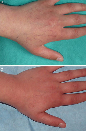 A. Paciente número 22 con telangiectasias residuales secundarias a hemangiomas situados en el miembro superior izquierdo. B. Práctica resolución de las telangiectasias tras una sesión de tratamiento.
