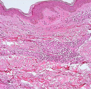 Lepra tuberculoide. En la dermis se encuentra inflamación granulomatosa compuesta por células epitelioides rodeadas de linfocitos (H-E x10).