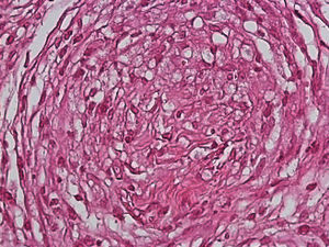 Granuloma en una lepra tuberculoide donde se aprecian histiocitos espumosos en aspecto concéntrico (H-E x40).