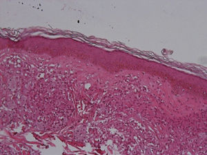Lepra lepromatosa. Atrofia epidérmica con zona grenz. Se observan macrófagos y cambios espumosos distribuidos alrededor de los vasos sanguíneos (H-E x10).