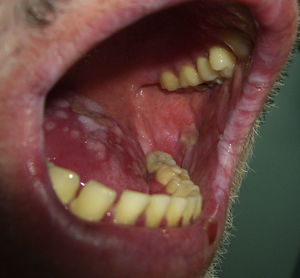 Pénfigo paraneoplásico (lesiones erosivas en la mucosa oral).