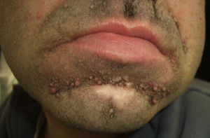Esclerosis tuberosa (angiofibromas faciales).