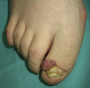 Esclerosis tuberosa (tumor periungueal de Koenen).