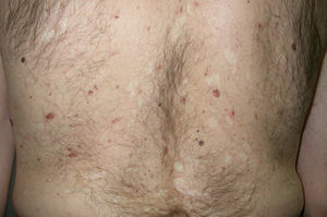 Síndrome de Gorlin (carcinomas basocelulares múltiples).