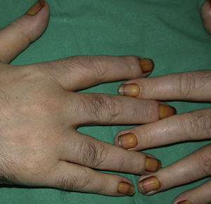 Síndrome de las uñas amarillas.