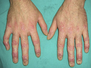 Pénfigo paraneoplásico (lesiones liquenoides en las manos y distrofia ungueal).