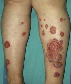 Pioderma gangrenoso superficial.