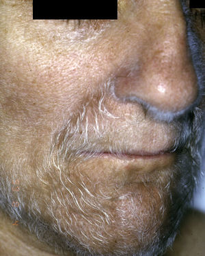 Hipertricosis lanuginosa facial (cortesía del Dr. J. Sánchez Estella).