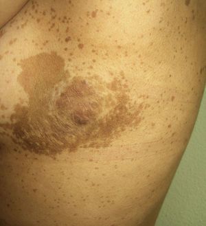 Neurofibromatosis tipo i (neurofibroma plexiforme).