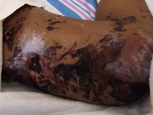Widespread areas of purpura and necrosis on right lower extremity with lysed bullae and crusting.