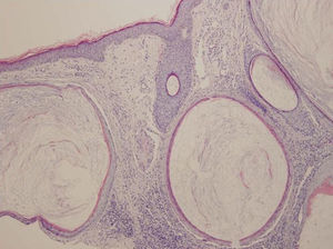 Quistes pilares infundibulares, con respuesta inflamatoria perifolicular granulomatosa tipo cuerpo extraño (hematoxilina-eosina x 10).