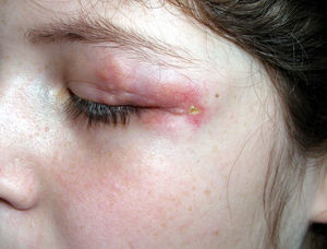 Placas rojo amarillentas en el área periocular.