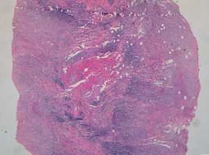 Infiltrado inflamatorio histiocitario con colágeno degenerado y depósito de lípidos (hematoxilina-eosina x 40).