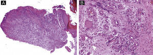 Granuloma piógeno. A) Hematoxilina-eosina ×10 mostrando hiperqueratosis y acantosis del epitelio y una tumoración polipoide, ulcerada y compuesta por canales vasculares. B) Hematoxilina-eosina ×40, detalle de la proliferación lobular de capilares incluidos en un estroma edematoso.