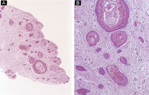 Inclusiones epidermoides subungueales. A) Hematoxilina-eosina ×10. La dermis contiene varias estructuras quísticas repletas de queratina. B) Hematoxilina-eosina ×40. Detalle de las inclusiones quísticas.