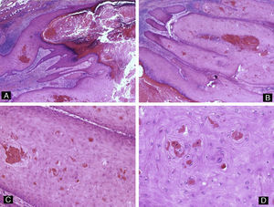 Queratoacantoma distal digital. Imagen de bajo aumento. A y B) Hematoxilina-eosina ×10 mostrando hiperqueratosis, acantosis e hipergranulomatosis del epitelio junto con una proliferación lobular de células escamosas intensamente eosinofílicas que proviene del epitelio. C) Hematoxilina-eosina ×20 y D) ×40 que muestran las células escamosas bien diferenciadas y de citoplasma brillante eosinofílico con disqueratosis focal.