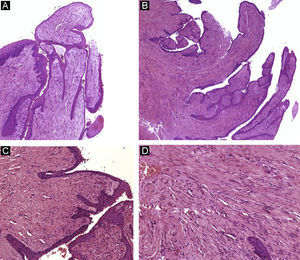 Onicomatricoma. A y B) Hematoxilina-eosina ×10 mostrando acantosis del epitelio y un tumor fibroepitelial con proyecciones vellosas. C) Hematoxilina-eosina ×20. Detalle de las proyecciones fibrosas recubiertas de epitelio. D) Hematoxilina-eosina ×40. Gran aumento mostrando las células fusiformes embebidas en estroma colagenoso.